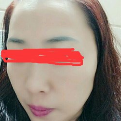 北京邦定張亞昆做的面部提升，果較為不錯~